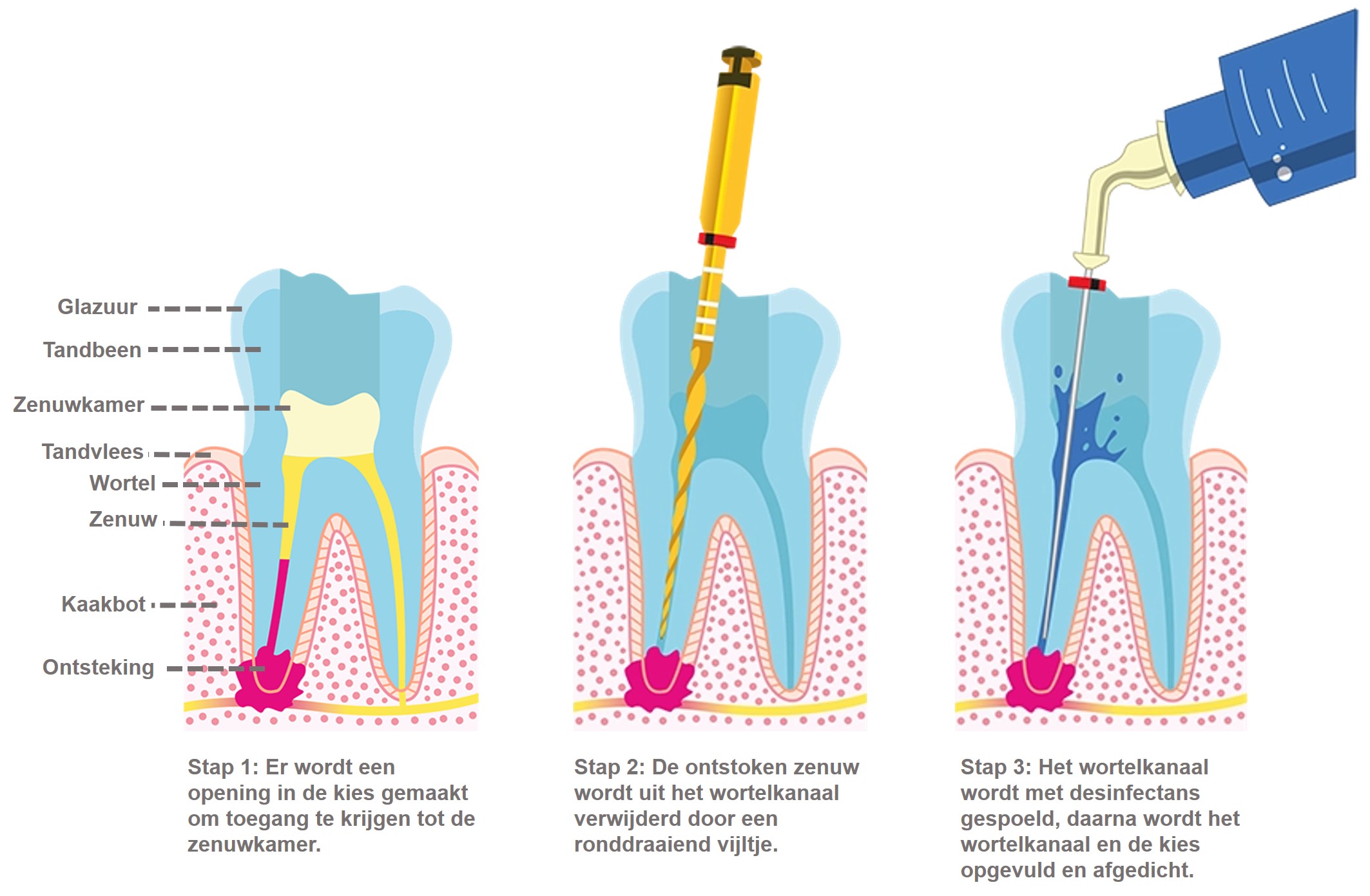 Endo procedure